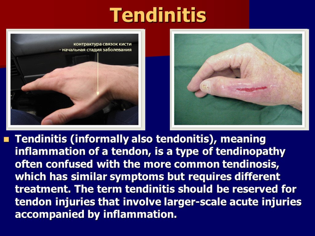Tendinitis Tendinitis (informally also tendonitis), meaning inflammation of a tendon, is a type of